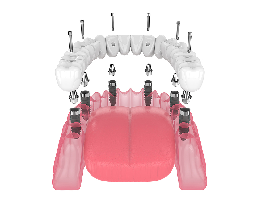 Transform Your Smile with All-on-6 Dental Implants: A Comprehensive Guide